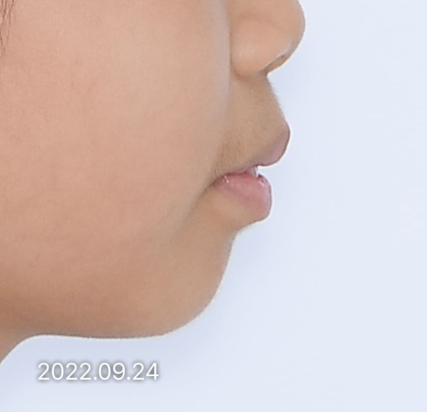 치료 전