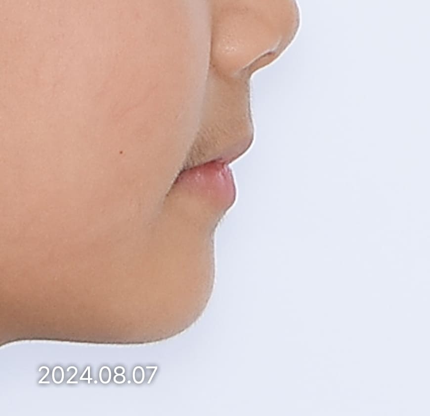 치료 후