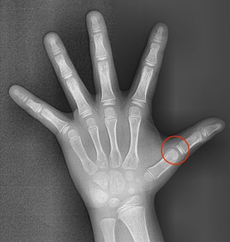 X-RAY 사진