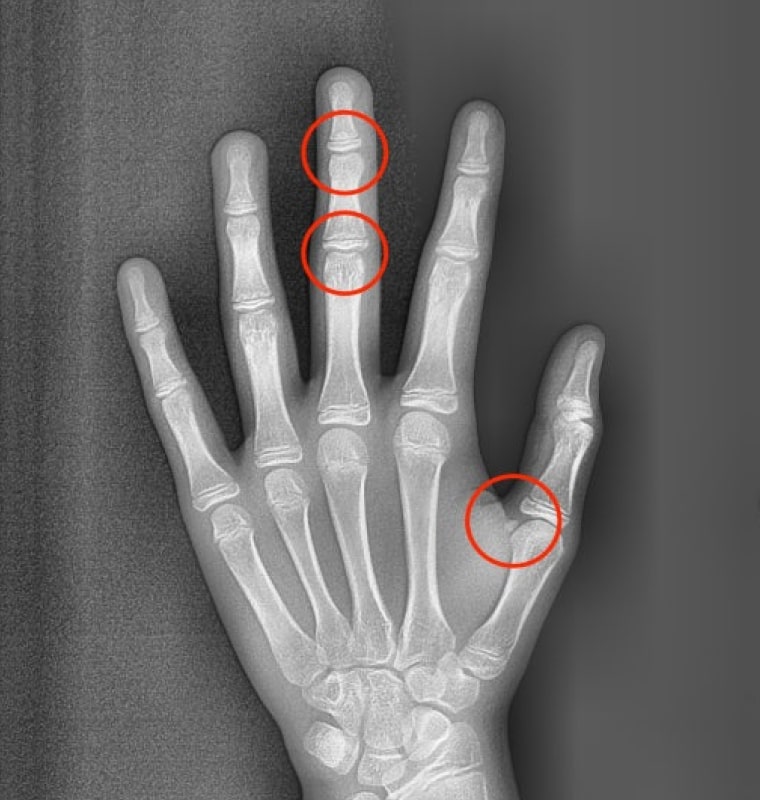 X-RAY 사진