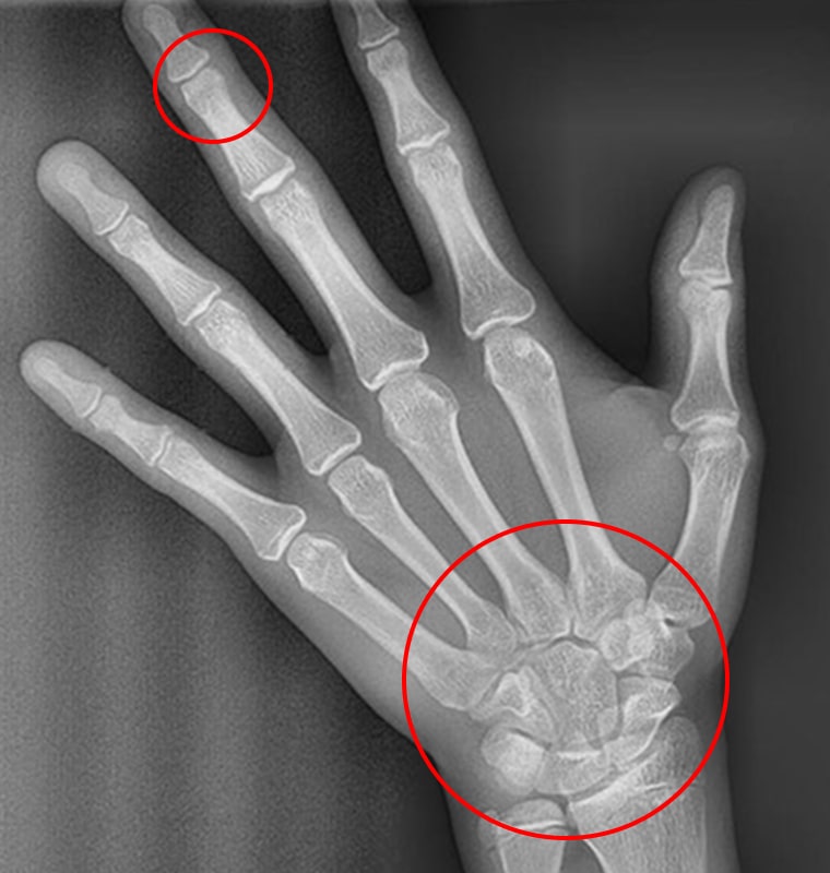 X-RAY 사진