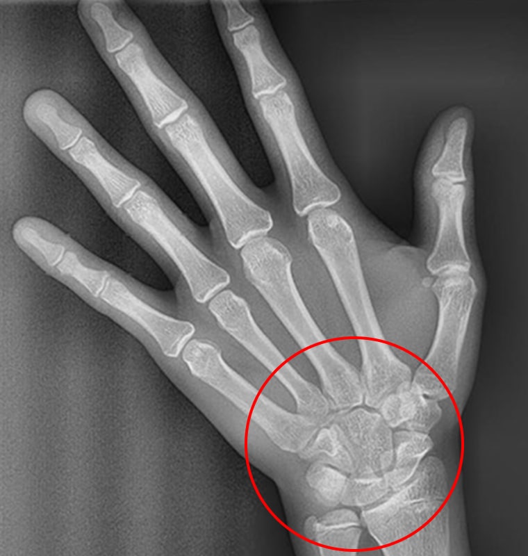 X-RAY 사진